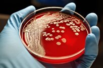  Global Response to Antimicrobial Resistance 'Insufficient'
