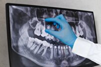 Iranian Researcher MHN Device to Find Calcified Root Canals in Tooth