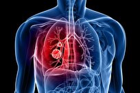 New Method Could Revolutionize Lung Cancer Treatment