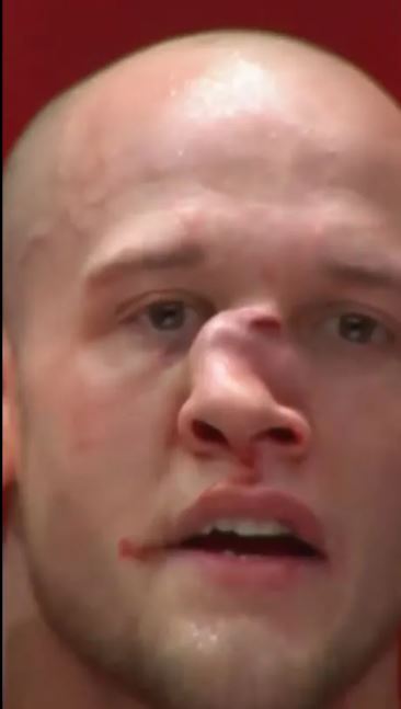شکستگی وحشتناک بینی یک ورزشکار MMA+تصاویر
