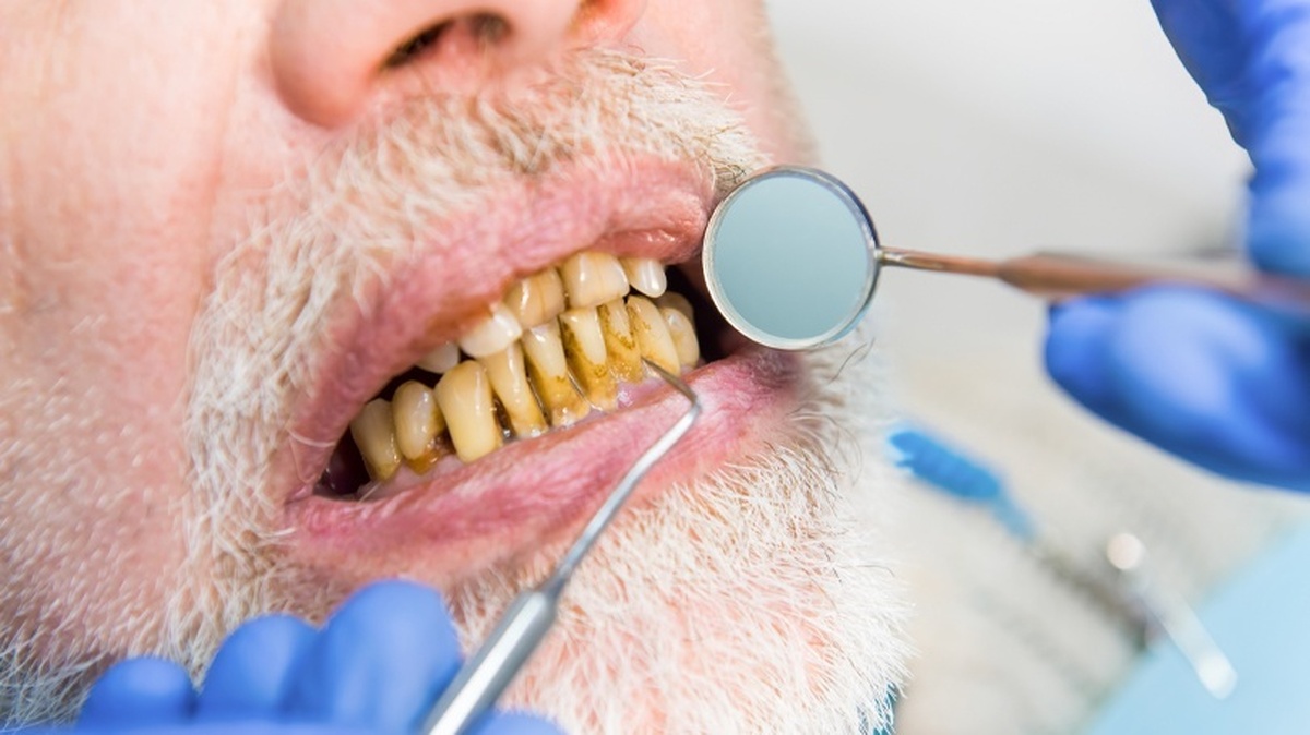 پوسیدگی دندان عامل برخی بیماری‌های گوارشی