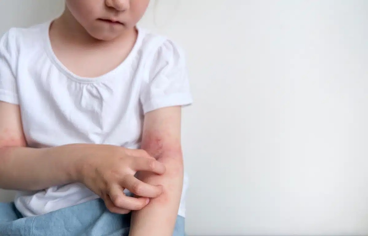 مواد حساسیت‌زا دور از دسترس کودکان باشد  ضرورت استفاده از لوازم پزشکی ضد حساسیت
