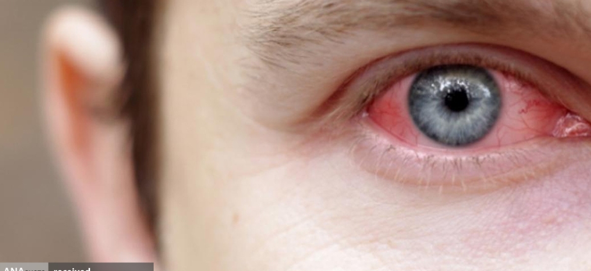 «یوئیت» سومین عامل بیماری‌های چشمی