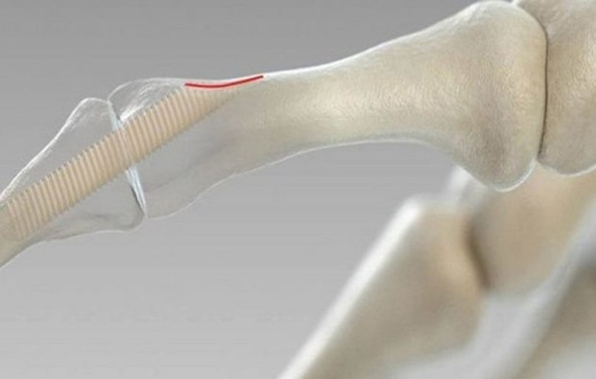 تثبیت‌کننده‌های زیست‌تخریب‌پذیر استخوانی ساخته شد/ کاربرد در جراحی‌های ارتوپدی