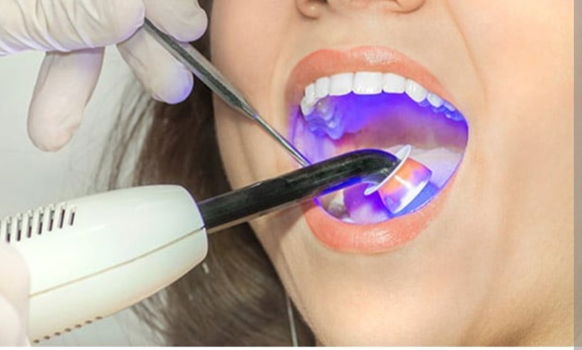دستگاه لیزر دندانپزشکی ایران‌ساخت در نمایشگاه نانو عرضه شد