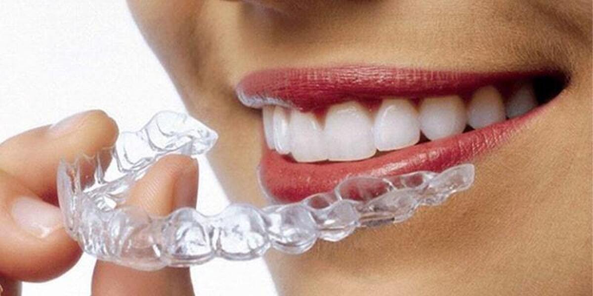 ارتودنسی‌های شفاف برای دندان بومی‌سازی شد
