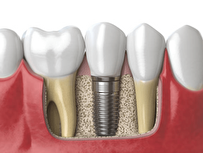 راهنمای انتخاب بهترین مرکز ایمپلنت دندان